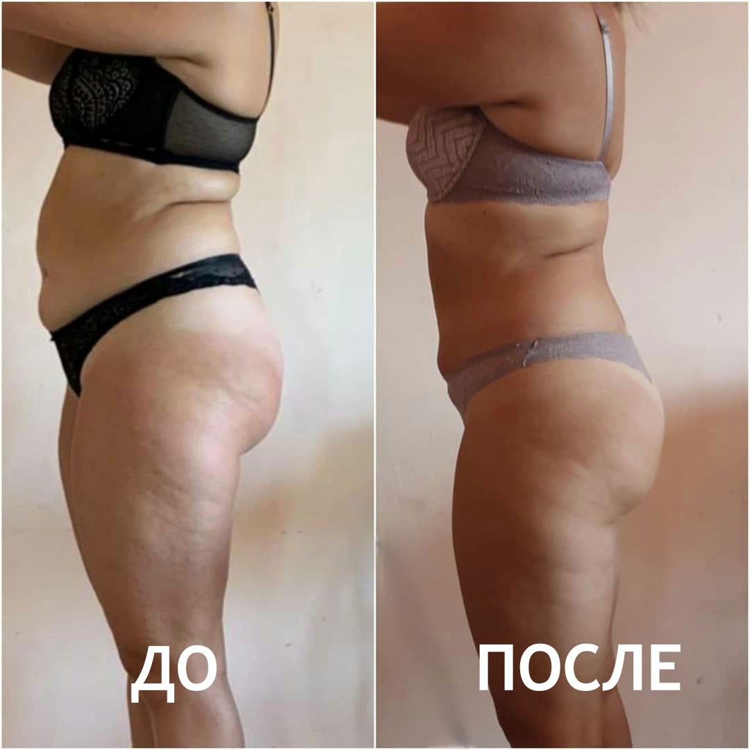 Антицеллюлитный массаж ДО и ПОСЛЕ